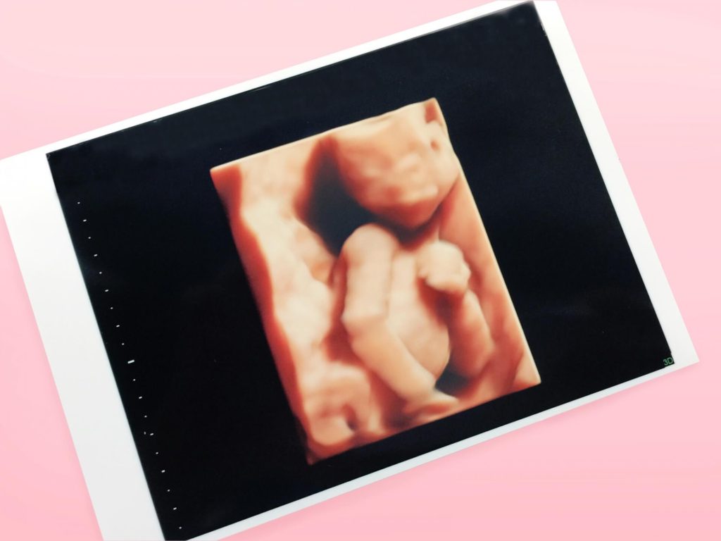 妊婦健診の超音波検査でわかる障害や病気はどんなものがある？
